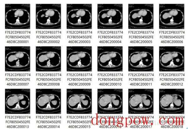 MicroDicom viewer