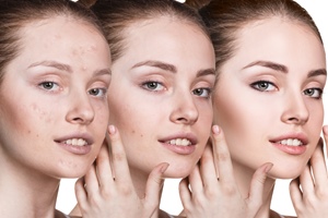 适合混合性皮肤用的护肤品 混合性皮肤护理小技巧