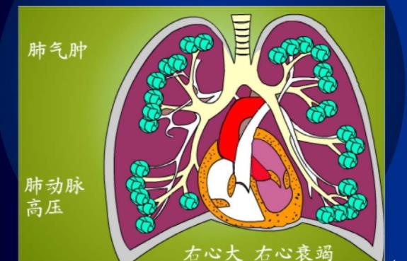 肺源性心脏病的症状有哪些 心肺衰竭咳嗽呼吸困难呼
