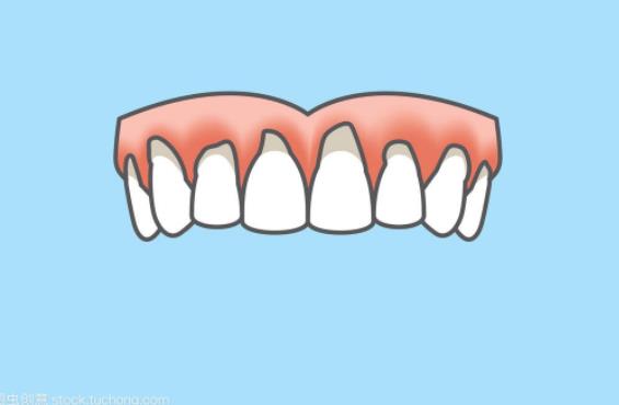 牙周炎怎么治疗 药物去除牙