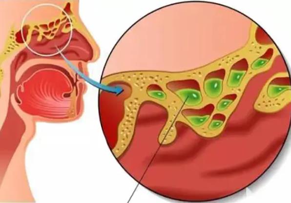 咽炎是怎么引起的 病毒细菌