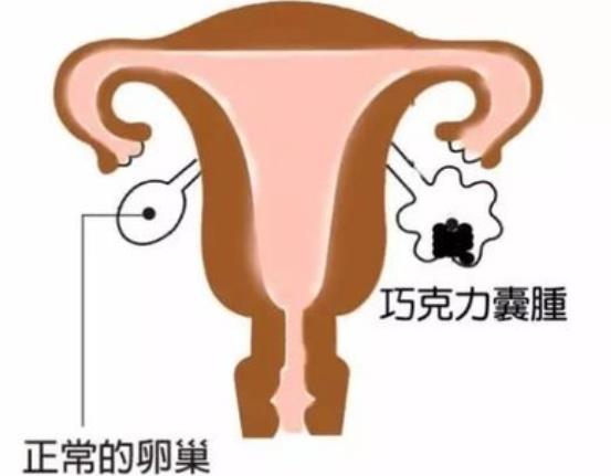 巧克力囊肿是怎么形成的 子宫内膜异位症三四十岁多