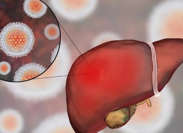 脂肪肝是什么意思 肝细胞内脂肪堆积过多代谢病变