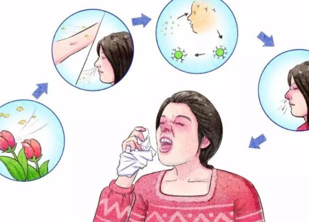 过敏性鼻炎怎么治最有效 原
