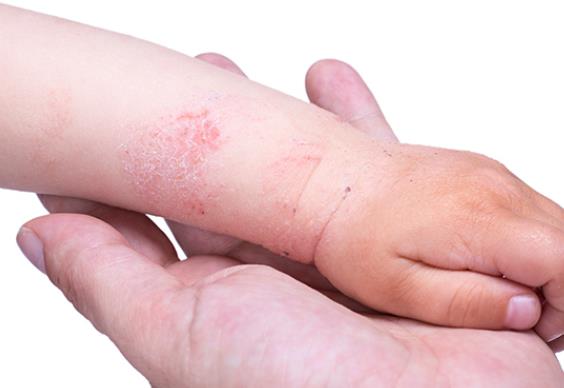 婴儿湿疹是怎么引起的 过敏