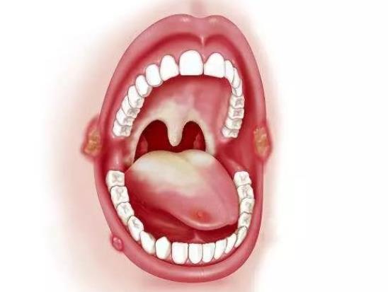 口腔溃疡怎么办 消除病因增