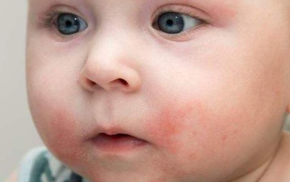 婴儿湿疹是热出来的吗 免疫