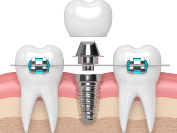种植牙齿的步骤和时间 术前检查7-12天拆线3—6个月