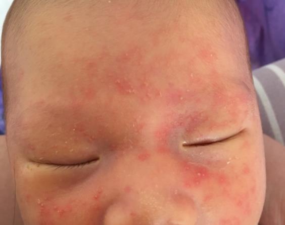 婴儿湿疹用什么药膏 红霉素软膏,维生素E软膏等