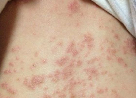 湿疹初期症状图片 小丘疹潮红瘙痒糜烂