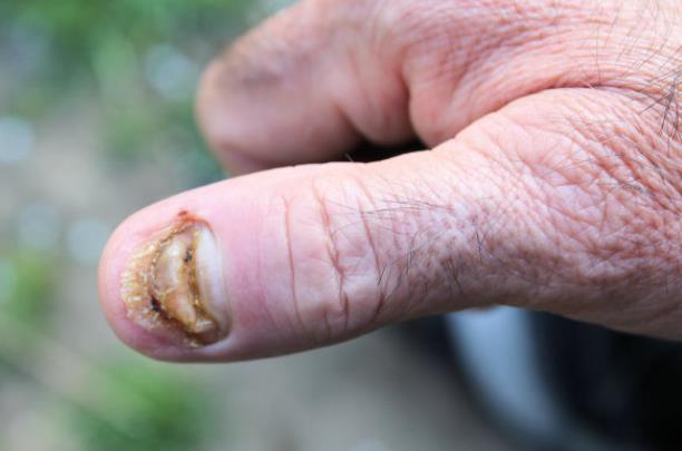 灰指甲是什么原因造成的 个人环境真菌感染身体病变