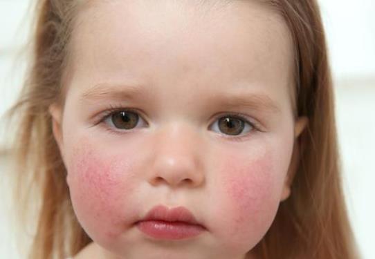 孩子过敏的症状有哪些 红斑,丘疹,风团,瘙痒等