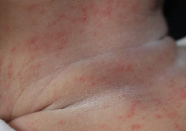 婴儿湿疹怎么处理 2%—3%硼