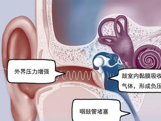 中耳炎是什么原因引起的 吸
