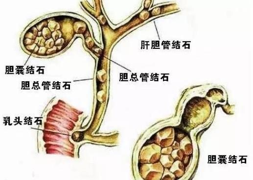 胆结石有什么症状 右上腹疼