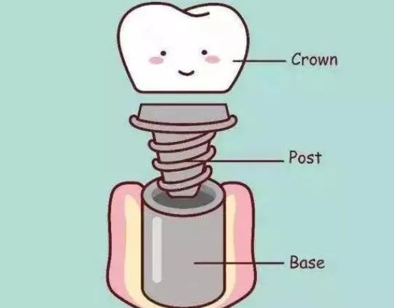 种植牙齿疼吗 轻微疼痛不适