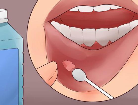 口腔溃疡是什么原因造成的 
