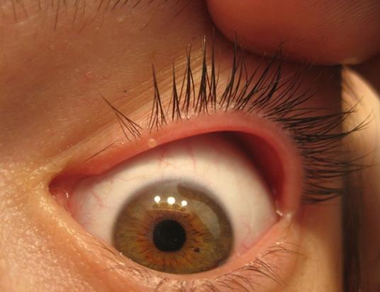 麦粒肿是什么原因引起 细菌感染抵抗力下降眼部疾病