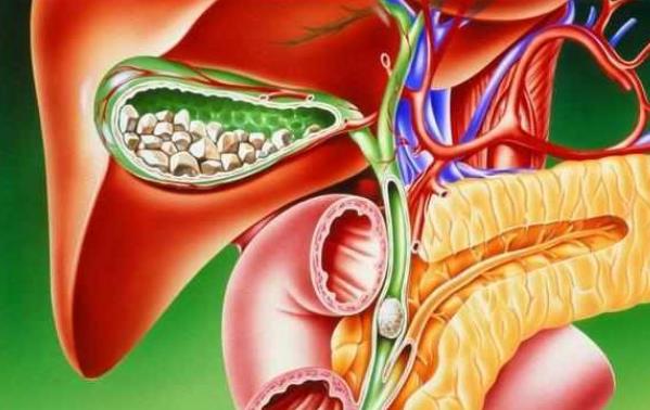 胆结石怎么形成的 胆汁成分
