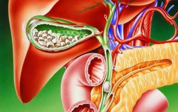 胆结石怎么形成的 胆汁成分失调淤积胆囊病变