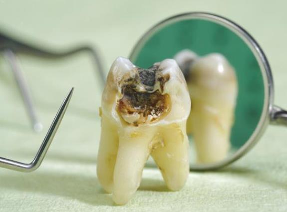补牙洞用什么填充材料 银汞