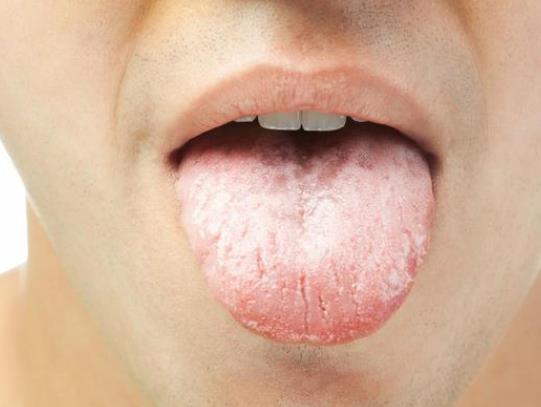 湿气重舌苔是什么样的 齿痕