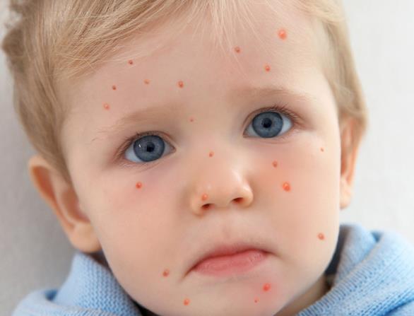 水痘疫苗几岁打 1-12岁一剂