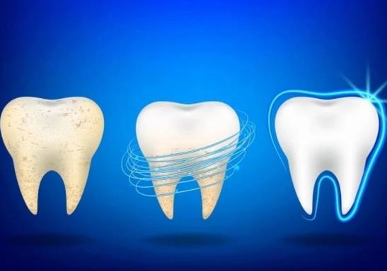 牙结石是如何形成的？长期用电