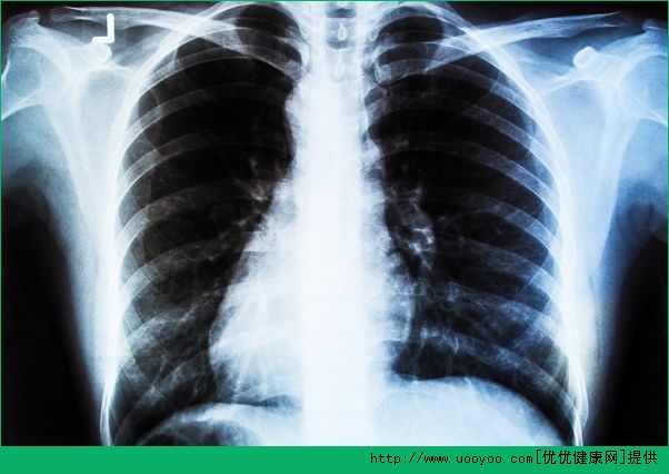 引起肺癌的原因 肺癌疾病有哪些症状？(3)