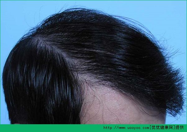 脂溢性脱发的症状是什么？脂溢性脱发是什么样的？[多图]