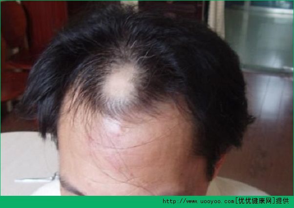 导致男人脱发的原因是什么？男人脱发的原因有哪些？(4)