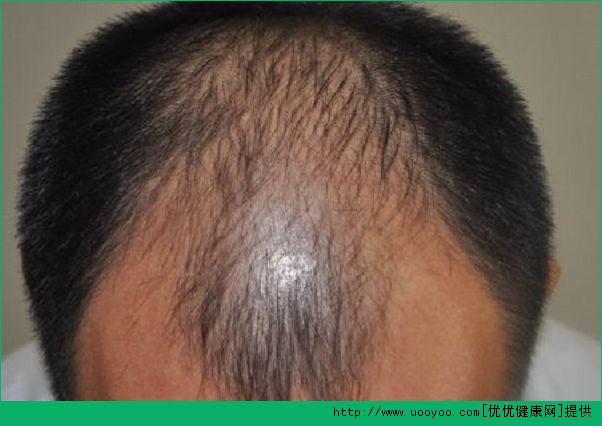 脱发的早期症状是什么？如何正