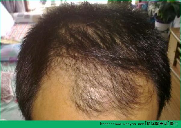脂溢性脱发是怎么得的？导致脂溢性脱发的原因是什么？[