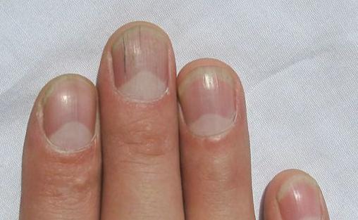 指甲有竖纹是肝脏问题吗？指甲