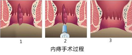 武汉江汉博仕医院：肛瘘手术多