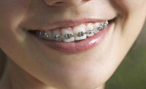 哪个年龄段适合牙齿正畸？戴牙