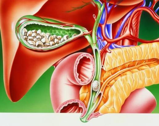 胆结石是怎么形成的？胆结石有