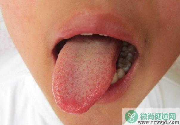 舌苔有裂纹会不会传染 舌头