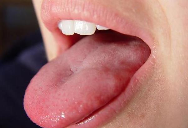 舌苔发黄是什么原因 消化道功能紊乱肝炎上火高温发