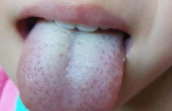 舌头发白是体内湿气重吗 舌