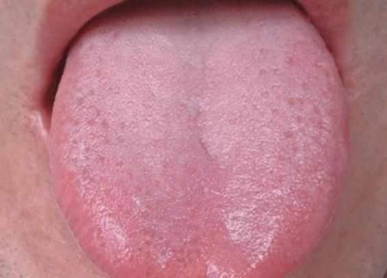 舌苔可以刮掉吗 舌苔白又厚怎么调理