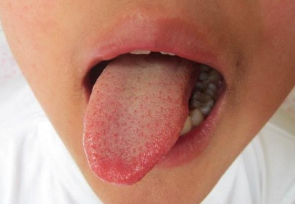 舌苔多久刮一次 舌苔刮不干净怎么回事