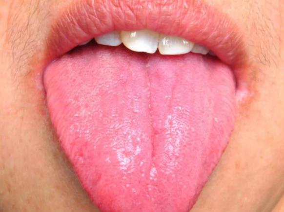 舌苔厚白是肾虚吗 舌苔厚白