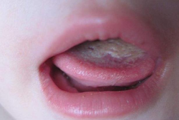 舌苔经常出血是怎么回事 血小板减少外伤口炎舌癌导