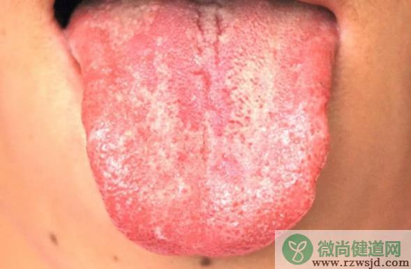 舌苔有裂纹是肾虚吗 裂纹舌会癌变吗