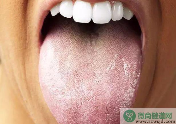 舌苔有裂纹是怎么回事 内分泌失调发育畸形病菌感染