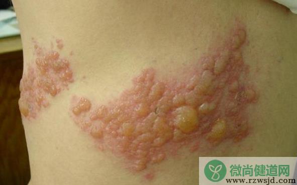 带状疱疹是什么引起的 水痘