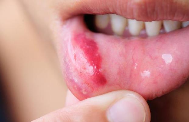 免疫力低会引起口腔溃疡吗 口腔溃疡是怎么形成的