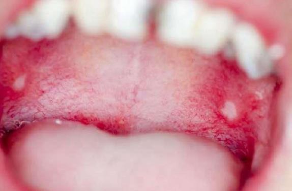 经常长口腔溃疡的危害 内分泌失调脏器恶变机体免疫