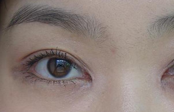 双眼皮疤痕增生期一般是多久 1-3个月,使用祛疤药物